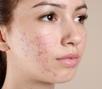 Acne: More Than Just a Skin Condition