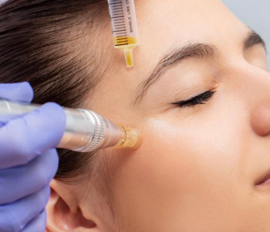 Microneedling $150